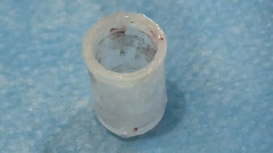 取出的塑料瓶蓋約花生米大小。重慶松山醫(yī)院供圖