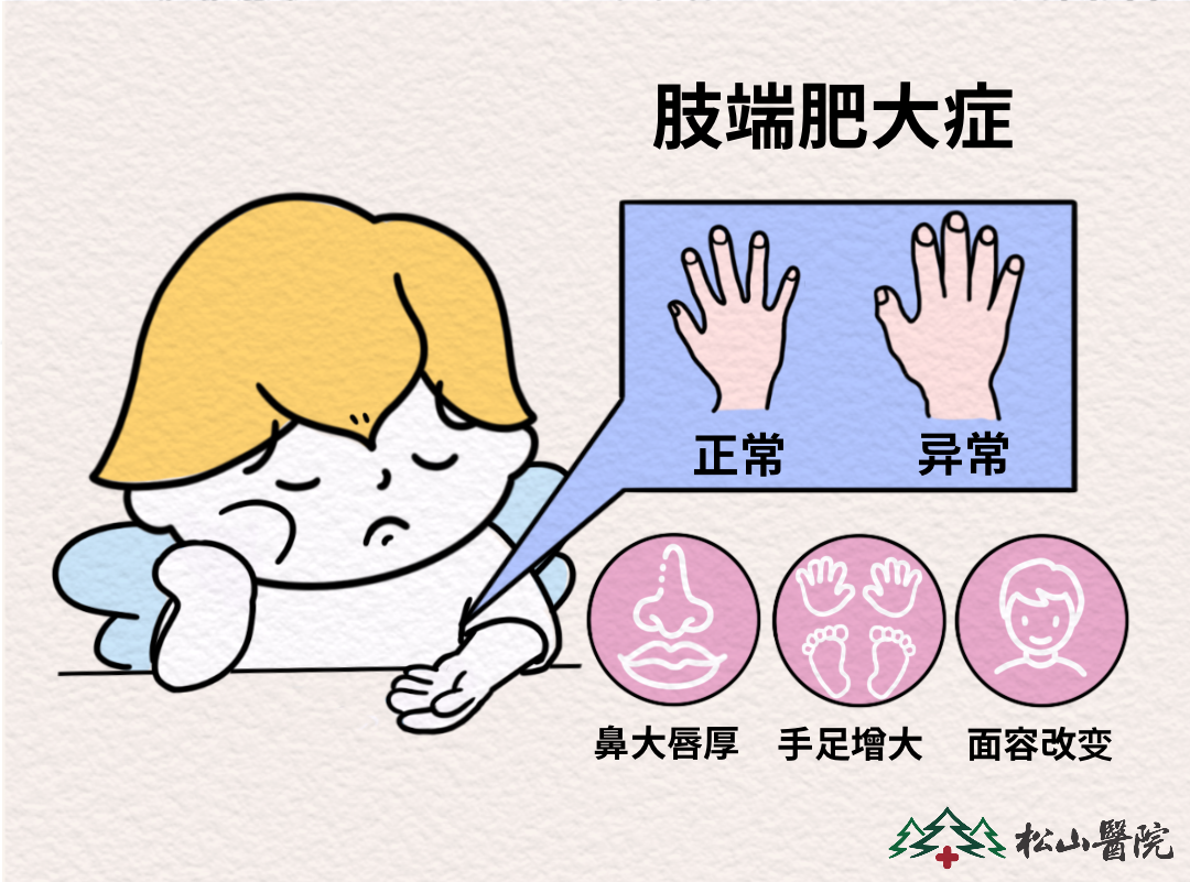 肢端肥大癥癥狀表現(xiàn)。重慶松山醫(yī)院供圖