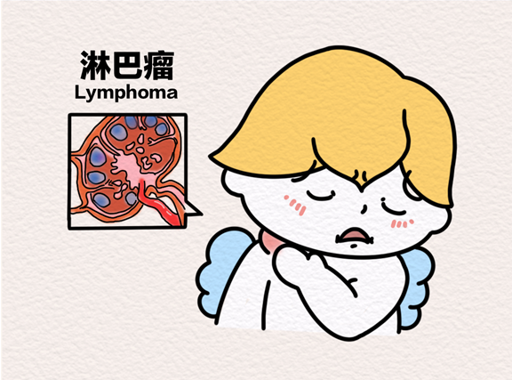 淋巴瘤。重慶松山醫(yī)院供圖