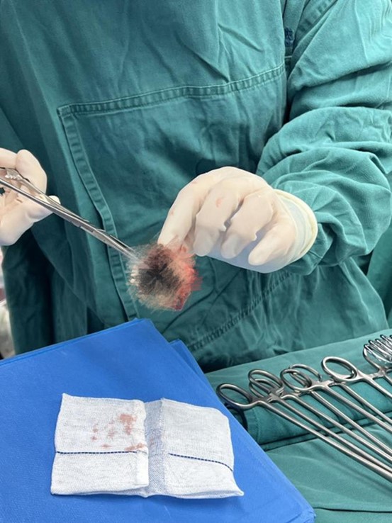 原置換瓣膜周邊已布滿血管翳和血栓。重慶康心醫(yī)院供圖