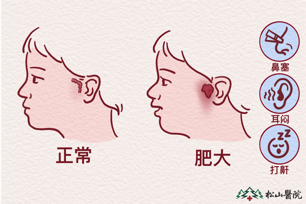 腺樣體肥大。重慶松山醫(yī)院供圖