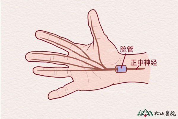 腕管綜合征。重慶松山醫(yī)院供圖
