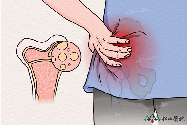 骨髓炎示意圖。重慶松山醫(yī)院供圖