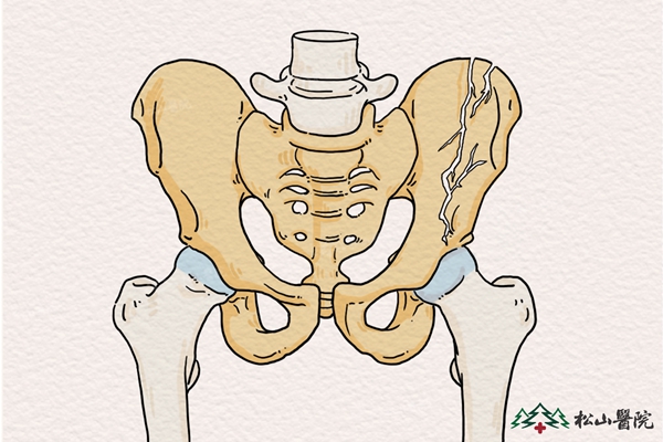 骨盆骨折示意圖。重慶松山醫(yī)院供圖