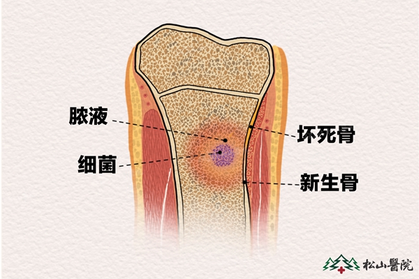 骨髓炎示意圖。重慶松山醫(yī)院供圖