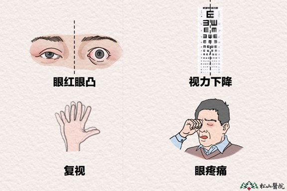甲狀腺相關(guān)眼病的常見(jiàn)癥狀。重慶松山醫(yī)院供圖