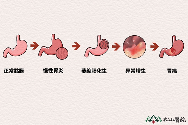 胃癌發(fā)展進(jìn)程。重慶松山醫(yī)院供圖