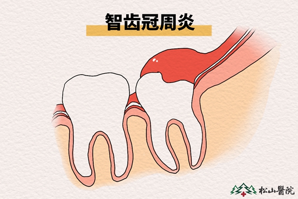 智齒冠周炎。重慶松山醫(yī)院供圖