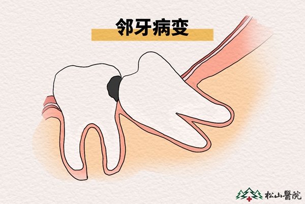 鄰牙病變。重慶松山醫(yī)院供圖