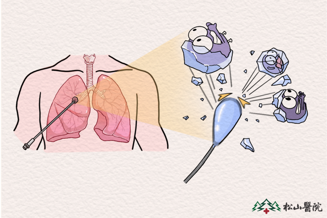 冷凍消融。重慶松山醫(yī)院供圖