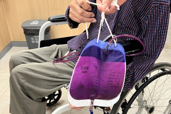 秦大爺出現(xiàn)“紫色尿液”。重慶西區(qū)醫(yī)院供圖