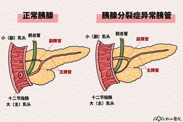 胰腺分裂癥示意圖。重慶松山醫(yī)院供圖