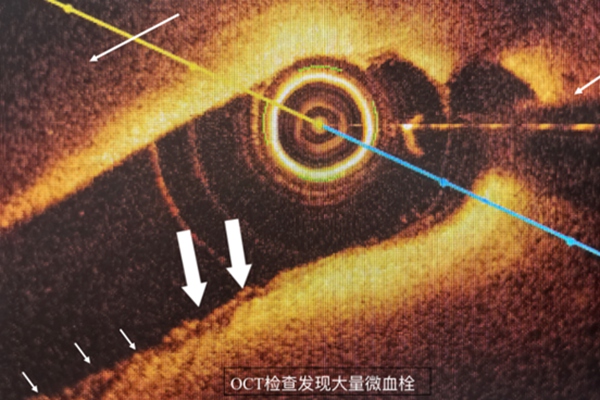 高分辨率光學(xué)相干斷層掃描（OCT）技術(shù)。重慶醫(yī)科大學(xué)附屬第二醫(yī)院供圖