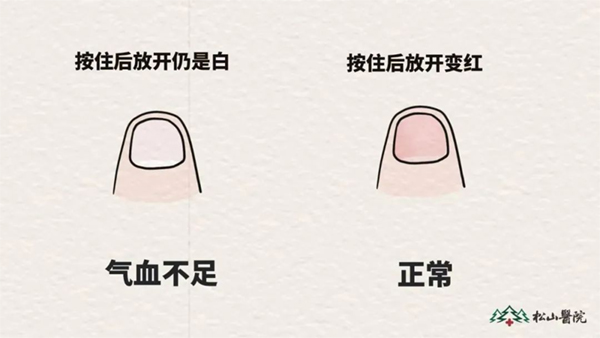 氣血不足與氣血充足時(shí)指甲對(duì)比。重慶松山醫(yī)院供圖