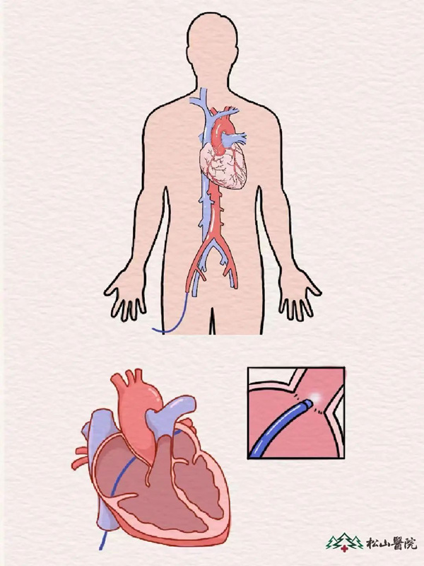 示意圖。重慶松山醫(yī)院供圖