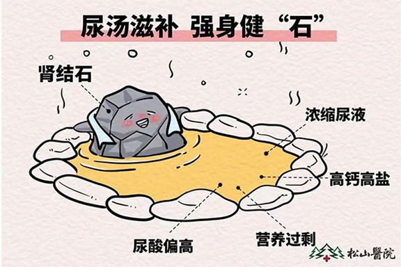 腎結(jié)石。重慶松山醫(yī)院供圖