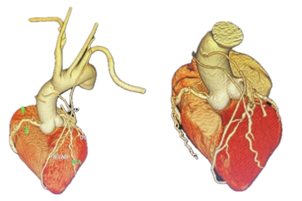 向先生冠脈造影三維重建圖。重慶醫(yī)科大學(xué)附屬第二醫(yī)院供圖