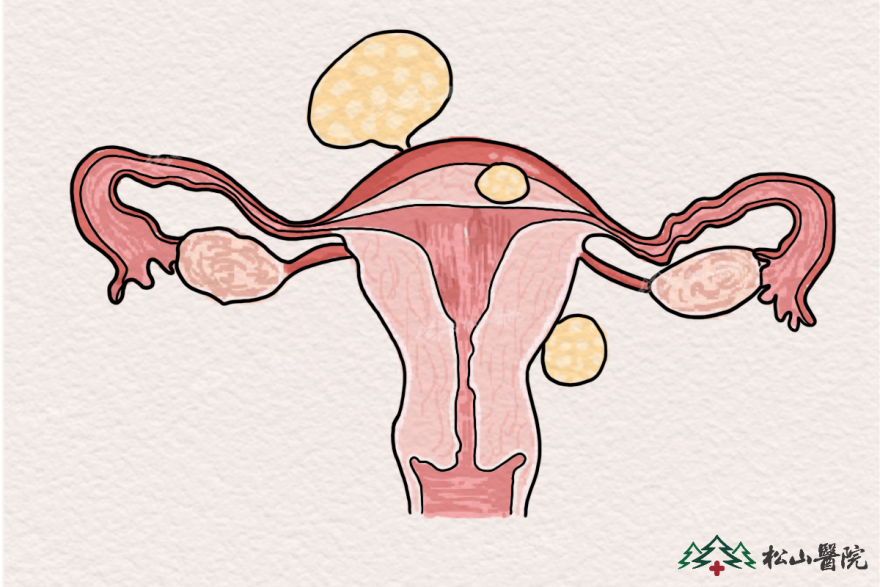 子宮肌瘤。重慶松山醫(yī)院供圖