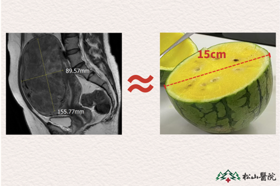 患者子宮肌瘤情況。重慶松山醫(yī)院供圖