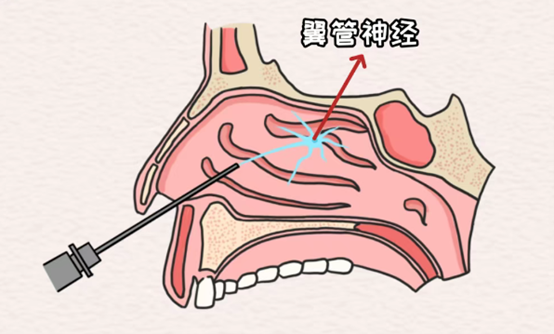 示意圖。重慶松山醫(yī)院供圖