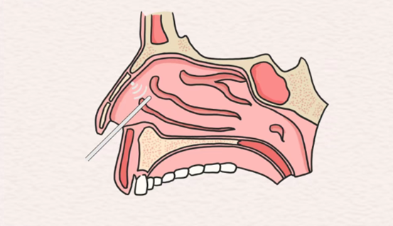 示意圖。重慶松山醫(yī)院供圖