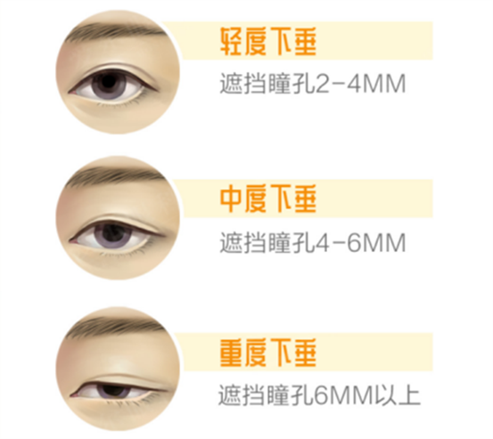 上瞼下垂示意圖。重慶南坪愛爾眼科醫(yī)院供圖