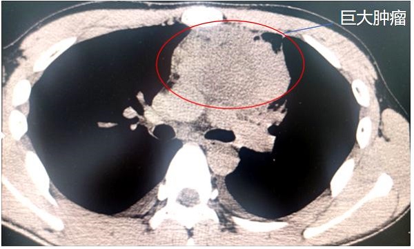 前上縱隔頸胸交界處巨大腫瘤。重醫(yī)附屬大學(xué)城醫(yī)院供圖