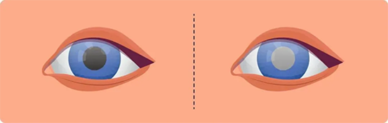 白內(nèi)障。重慶南坪愛(ài)爾眼科醫(yī)院供圖