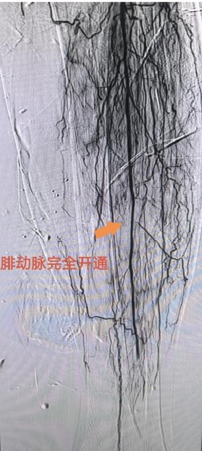 術(shù)后，患者左腿部腓動脈血管完全開通。重醫(yī)附屬大學(xué)城醫(yī)院供圖
