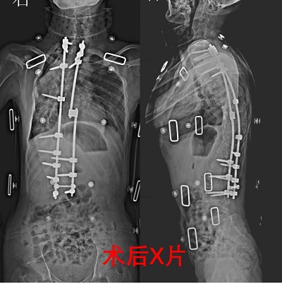 術(shù)后x片顯示，患者脊柱情況得到明顯改善。重醫(yī)附二院供圖